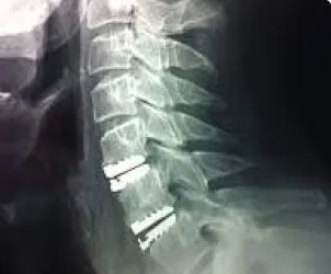 Doença Discal